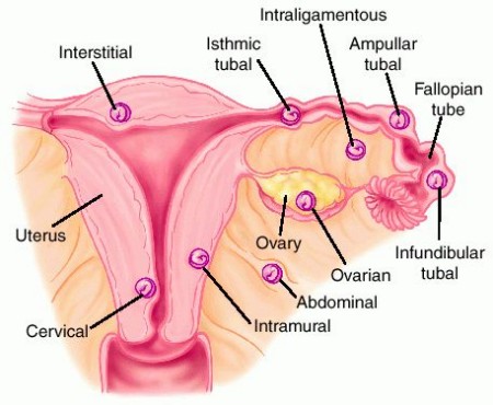 Mang thai ngoài tử cung - dấu hiệu, phòng ngừa và điều trị