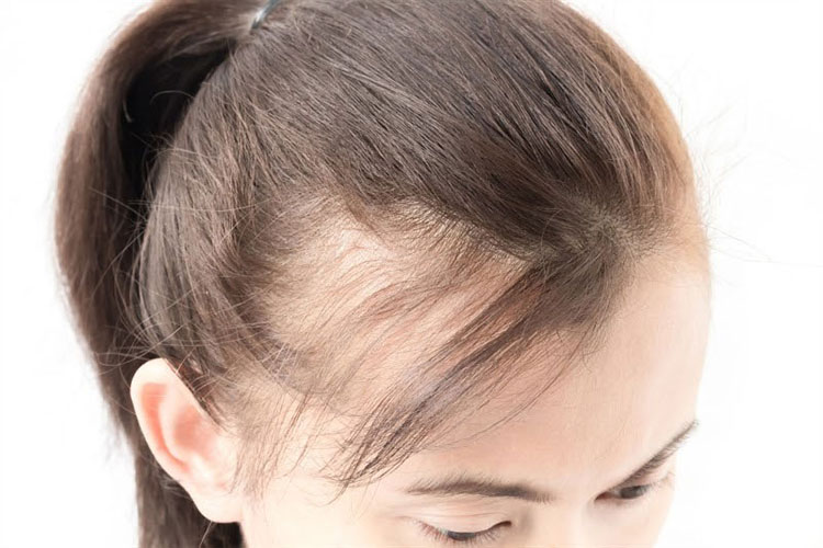 Những kiểu tóc cho người hói đầu giúp lấy lại sự tự tin  Tóc giả LUXY