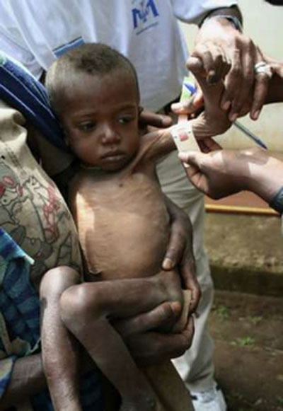 Ảnh báo động về trẻ em suy dinh dưỡng ở Somali