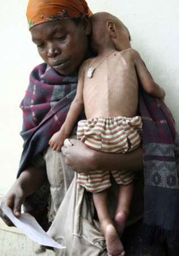 Ảnh báo động về trẻ em suy dinh dưỡng ở Somali