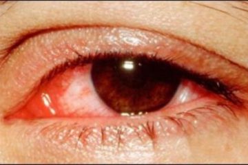 Đau mắt đỏ có ảnh hưởng đến thai nhi?