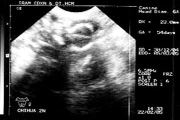 Bụng rất nhỏ khi mang thai 18 tuần thì sự phát triển của thai nhi có bình thường không?