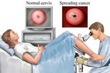 Hoạt động tình dục – căn nguyên chủ yếu của bệnh ung thư cổ tử cung