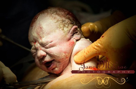 Một em bé ra đời bằng phương pháp mổ lấy thai.