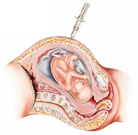 Một trong những xét nghiệm chẩn đoán phổ biến nhất để phát hiện các bất thường ở thai nhi là chọc dò ối