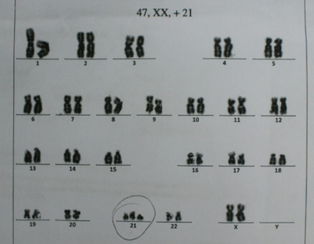 Trẻ bị bệnh Down thường có 47 nhiễm sắc thể vì có đến ba nhiễm sắc thể thứ 21 (hiện tượng nhiễm sắc thể tam đồng)