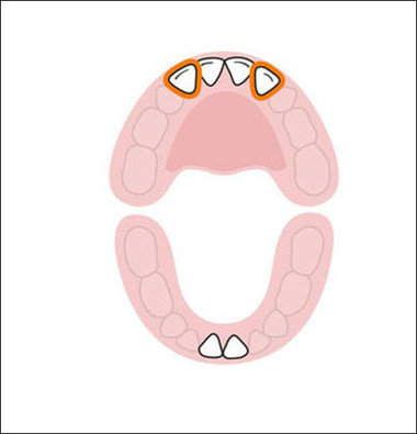 2 chiếc răng cửa phía trên tiếp theo mọc khi bé được 9- 13 tháng tuổi. Vậy là hàm trên của bé đã có 4 chiếc răng cửa.